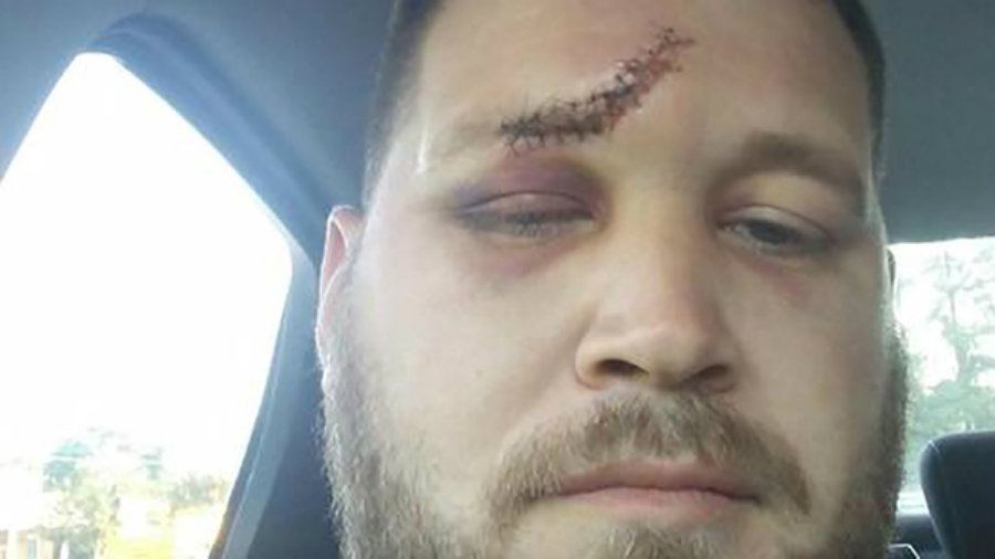 Sanders took a selfie after he got the proper treatment for his wounds showing a massive hit on his forehead. His girlfriend and her ex-husband are currently in custody. Image Credit: WSOCTV