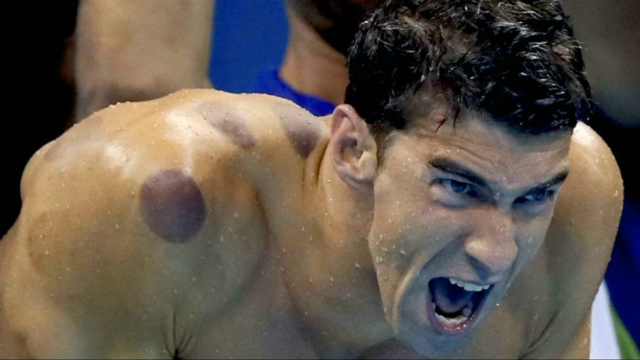 Cupping was thrown into the global spotlight when we wonder why Michael Phelps was covered with purplish circles on his back and shoulders. Photo credit: IB Times