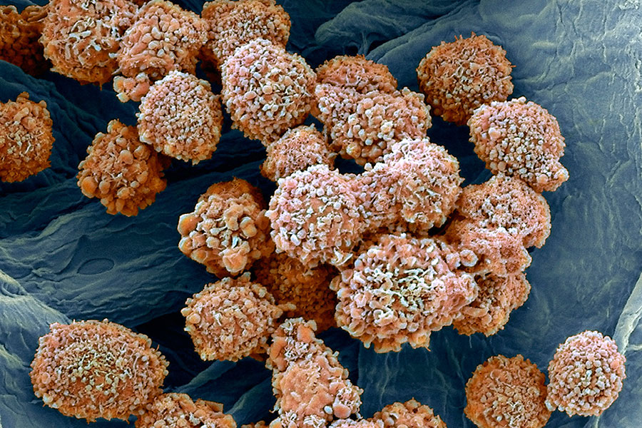 breast-cancer-cells