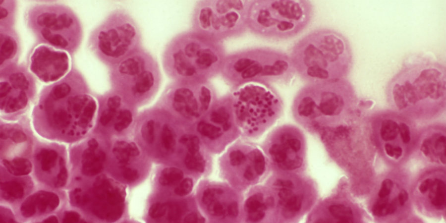 It was discovered that new cases of gonorrhea have developed resistance to azithromycin and ceftriaxone, the most common drugs to treat STDs. Photo credit: Std-gov.org