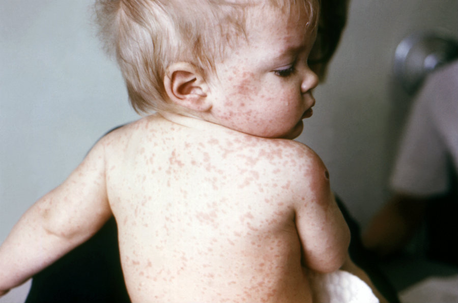 The Americas region is free of endemic measles. Photo credit: CDC