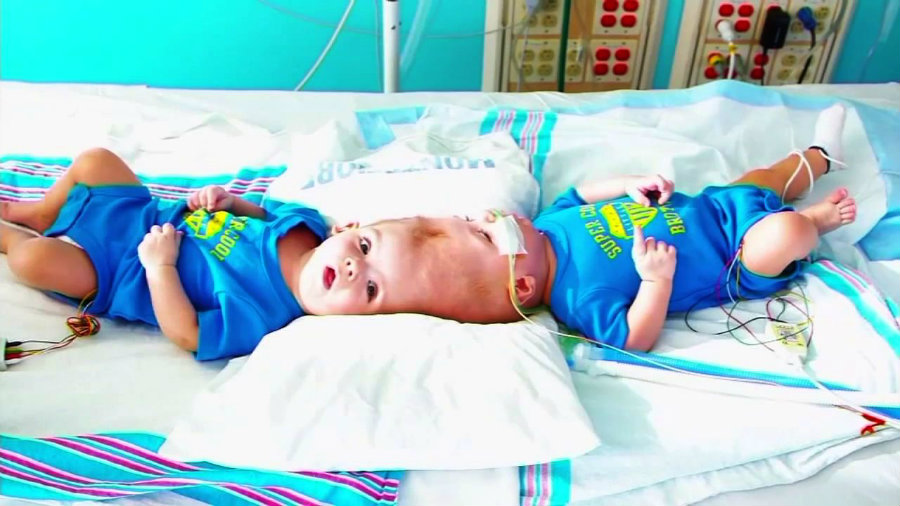 Conjoined Twins Separated After Huge Surgery Thrived And Have Started