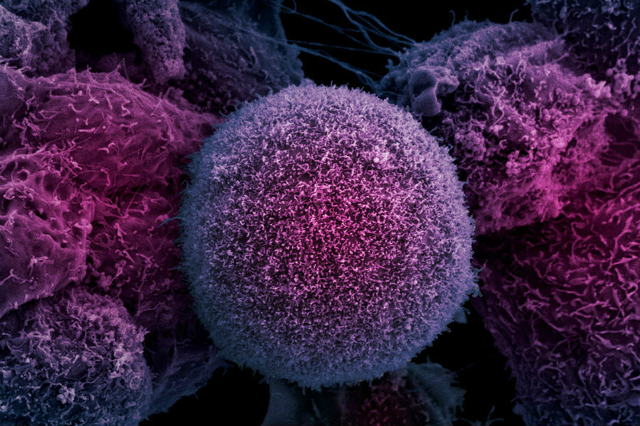 prostate-cancer-cells