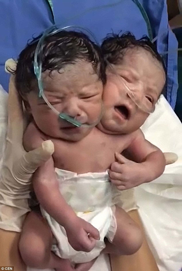 The conjoined twins in Mexico who were born sharing the same body but having separate heads and brains have died. Image Credit: Lared Noticias Juarez/ YouTube