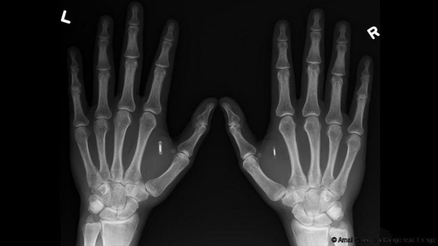 Epicenter's microchip Implant X-ray