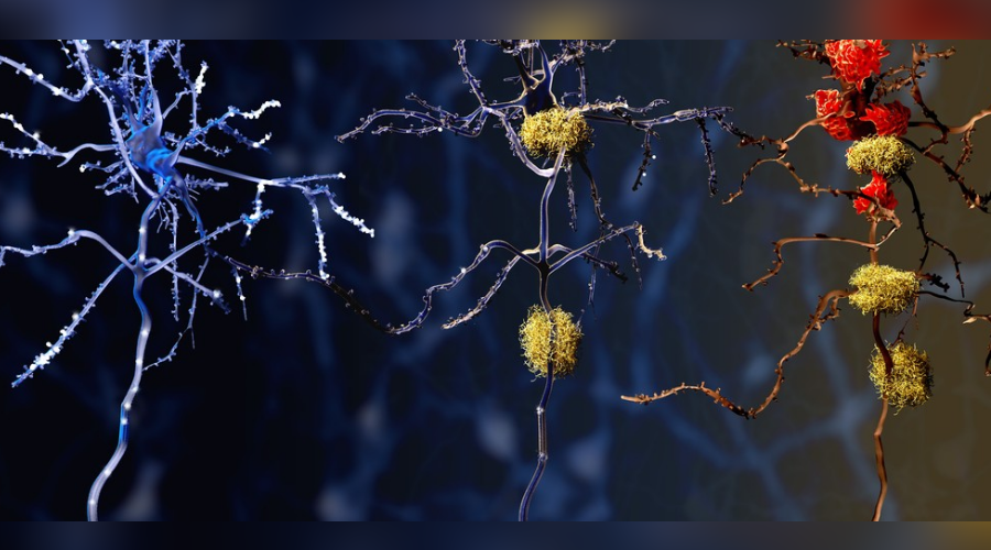 High insulin levels ay increase amyloid accumulation in the brain, therefore potentially increasing the risk of suffering from Alzheimer's. Image credit: Alzheimer News Today