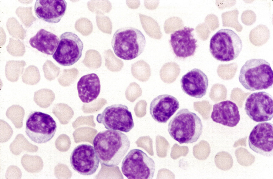 FDA advisory committee recommends approval of T-cell 'living drug' to treat leukemia. Image credit: Blood Journal