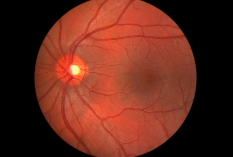 A healthy human retina. Image Credit: Pepose Vision Institute