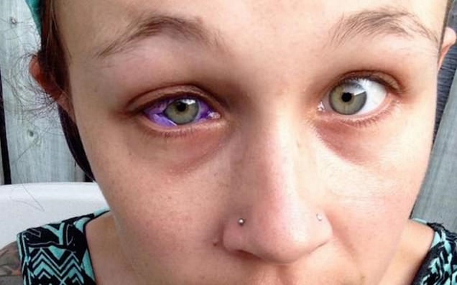 Gallinger risks losing her eye for getting a scleral tattoo. Image credit: Catt Gallinger / Facebook.