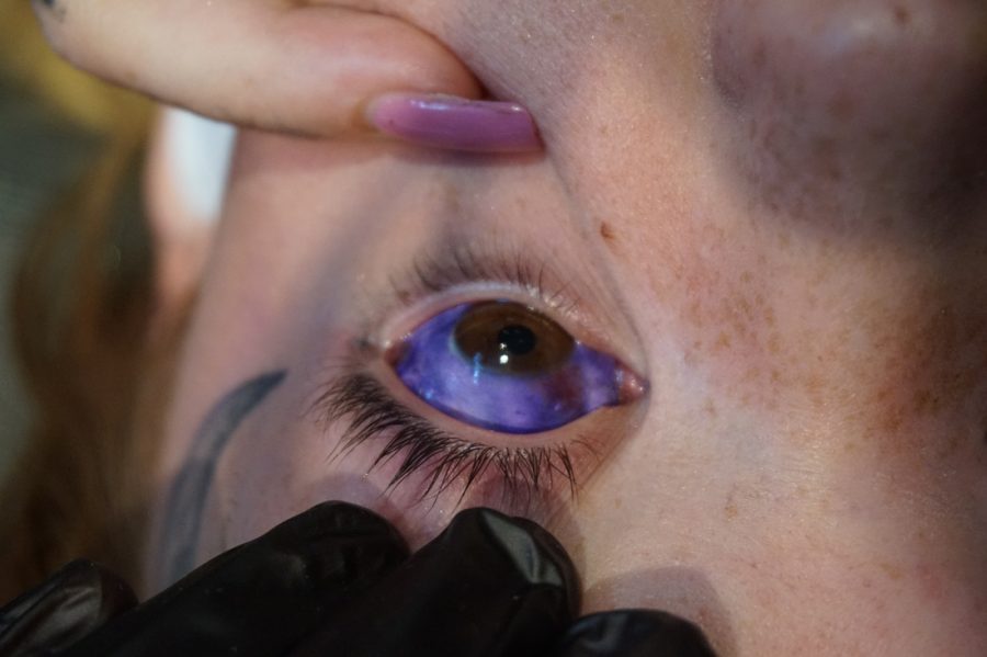 A scleral tattoo performed correctly. Image credit: Dylan Riverdale