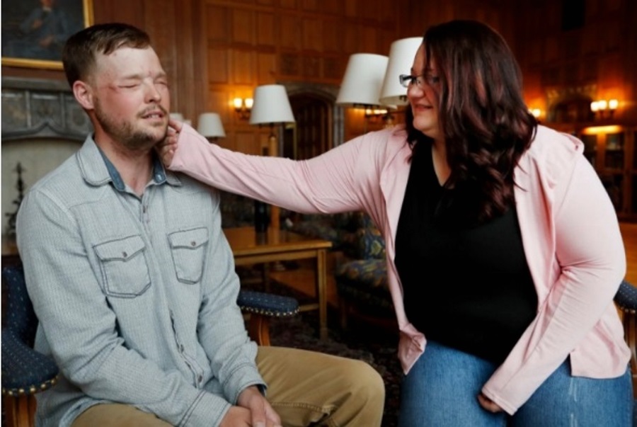 Mayo Clinic, Face transplant Minnesota, Andy Sandness