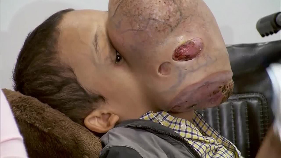 14-year-old boy from Cuba with a 10-pound tumor, Basketball-size tumor, Miami