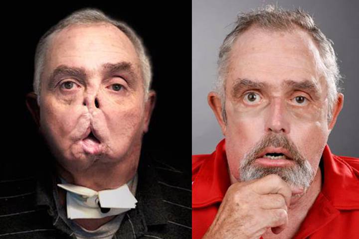 Face Transplant Patient Maurice Desjardins