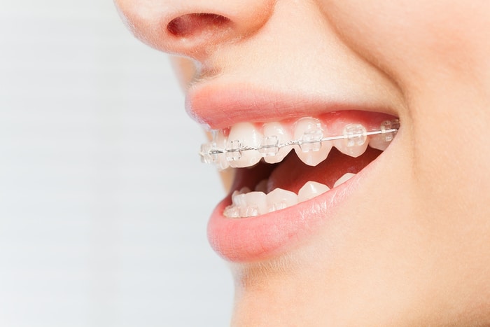 What You Need to Know Before Getting Braces