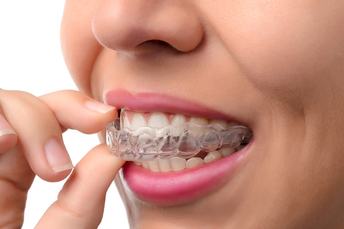 How To Know If Invisalign Is Right For You