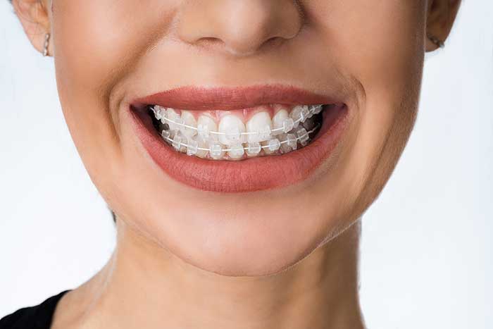 Discovering The Truth: Is Invisalign as Effective as Braces?