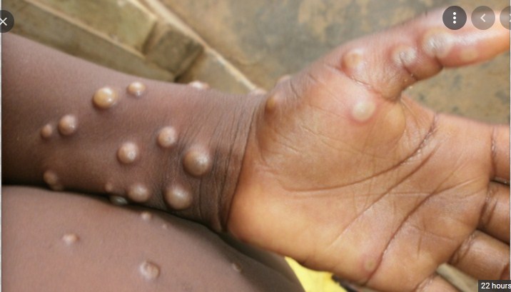 Dallas Resident Traveling From Nigeria Infected With Monkeypox; CDC Investigates