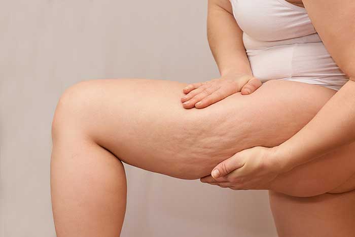 Think You’ve Tried Everything to Eliminate Your Cellulite? Keep Reading