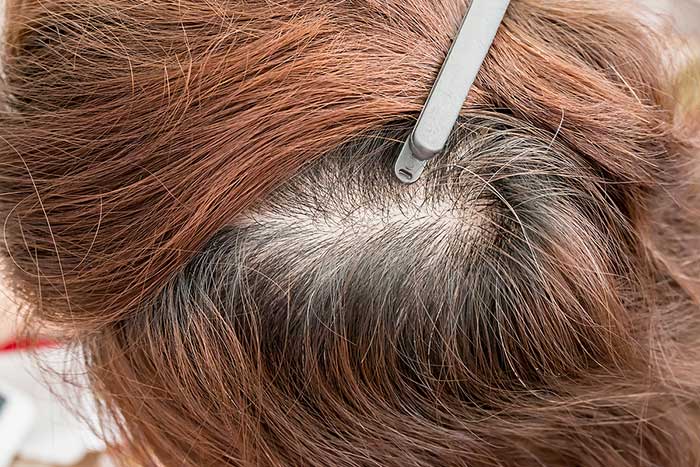 Does Thinning Hair Come Back?